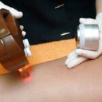 laser hair removal