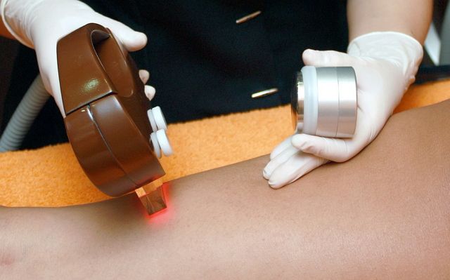 laser hair removal